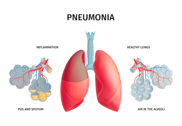 12 November Hari Pneumonia Sedunia Cek Gejala dan Cara Cegahnya 