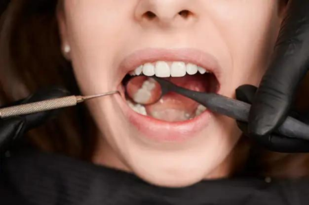 Penyebab warna gigi menjadi hitam dan pertanda potensial pembusukan